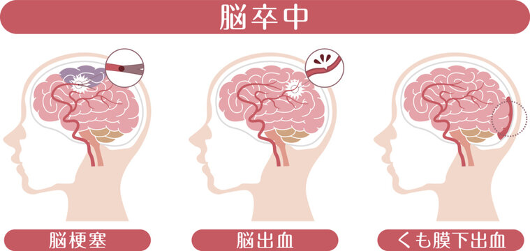 Stroke types brain infarction cerebral hemorrhage subarachnoid hemorrhage medical illustration	
