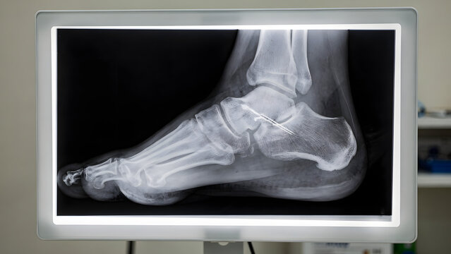 Ankle X Ray With Fracture Detail