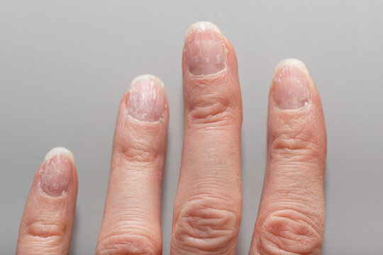 Damaged fingernails with white patches and dry cuticles on fingers close-up. A hand with problematic cuticles and broken nails. Emotional stress. Age-related skin changes. Hand care.