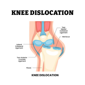 Knee dislocation joint knee disease. Labeled tear ligament, meniscus, torn ligament, fibula. Acute trauma injury mechanism. Synovial joint anatomy Frontal view of human knee joint Vector illustration.