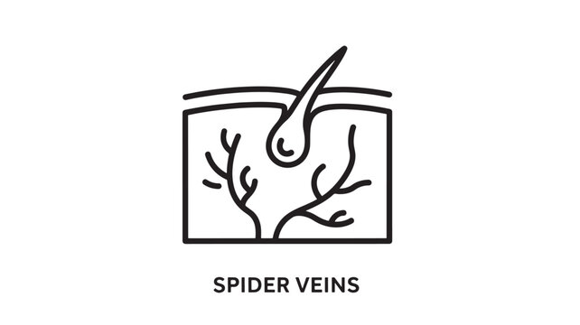 A medical illustration showing spider veins under the skin, useful for healthcare and medical advertising, education materials.