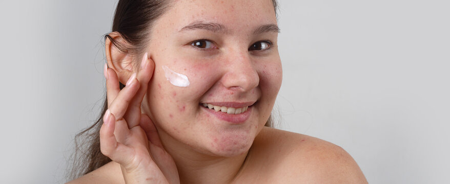 Pimple treatment cream on cheek. Pimple skincare routine for face. Pimple acne care on sensitive oily skin. Pimple dermatology solution. Cream for acne pimples. Facial cream for sebum skin.