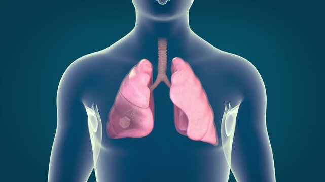 Pneumonia illness, healthy lungs and disease lungs, Human Lungs cancer, Cigarette smokers Lung disease, cancerous malignant tumor growing and spreading, respiratory system, asthma infection. 3D.
