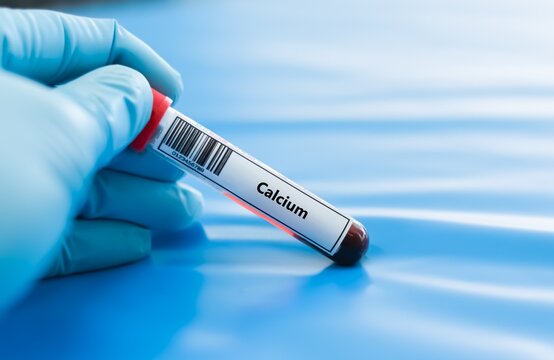 Blood sample tube for calcium test analysis.