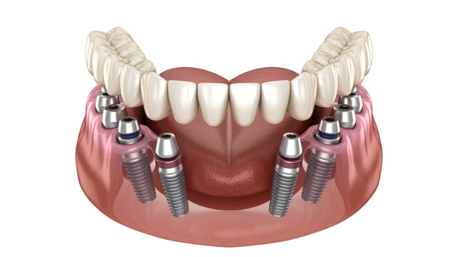 Illustration of dental implants supporting a fixed bridge for lower teeth replacement isolated on white background