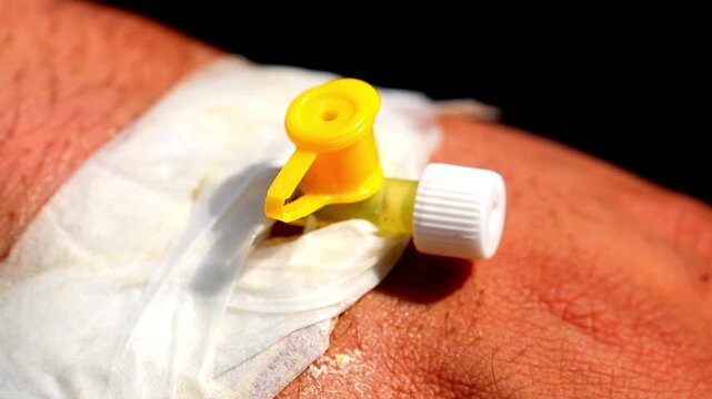Slow Motion Macro Shot of Intravenous catheter inserted in the arm of a patient, secured with bandage in a clinical setting at 180 fps High quality footage