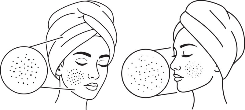 Illustration of a woman with skin blemishes and acne spots with clear skin with szczeg owy with powi kszenie with tr dzik with piel gnacja with pi kno