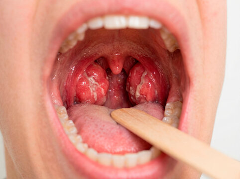 Inflammation de la gorge