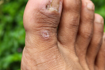 Fototapeta premium skin in the form of small lumps or lesions that resemble warts (verruca) or corns (clavus) on the base of a man's big toe