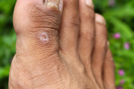 skin in the form of small lumps or lesions that resemble warts (verruca) or corns (clavus) on the base of a man's big toe