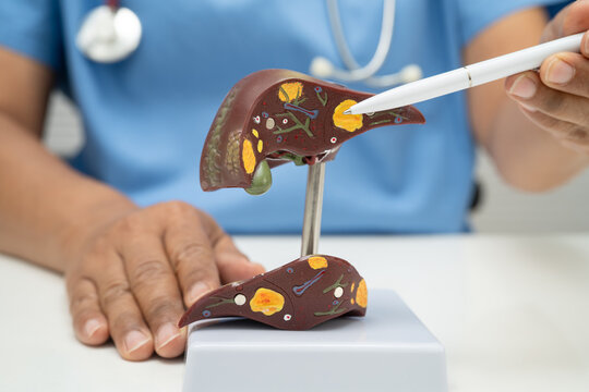 Cirrhosis, Liver cancer, fatty liver, Asian doctor with liver human anatomy model in World Hepatitis Day at hospital.