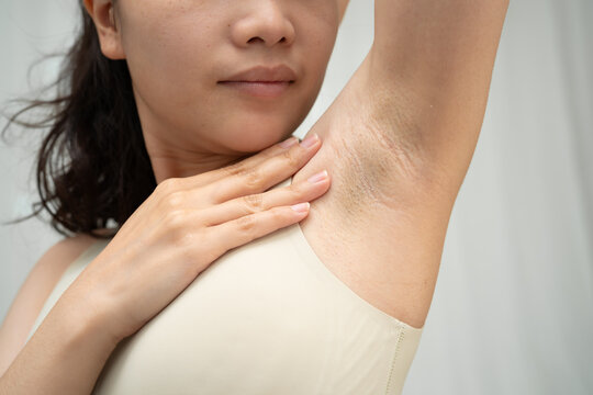 Asian woman have problem black armpit beauty skin care.