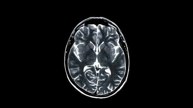 Detailed MRI of the human brain on a black background. Magnetic resonance imaging for brain diagnosis in high contrast. Fast animated brain scan
