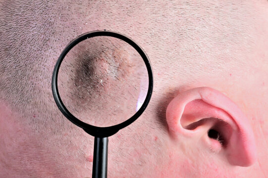 Medical close-up of actinic keratosis on scalp under magnifying glass for dermatology education and skin cancer awareness