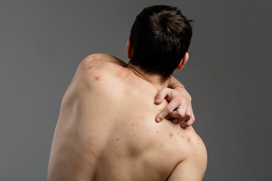 The young man's back is covered with pimples and signs of inflammation. The concept: men's health and untimely visits to the dermatologist, skin problems due to blood diseases and malnutrition
