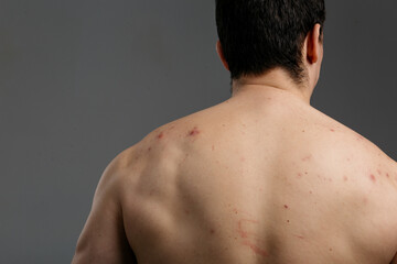 Fototapeta premium The young man's back is covered with pimples and signs of inflammation. The concept: men's health and untimely visits to the dermatologist, skin problems due to blood diseases and malnutrition