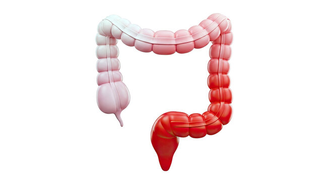 3D Illustration of Human Colon with Inflammation