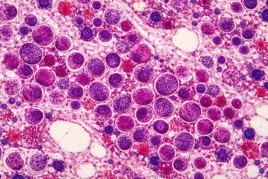 Study of bone marrow showing erythroid hyperplasia in reactive states