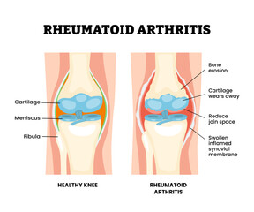Fototapeta premium Rheumatoid arthritis knee injury. Labeled bone erosion, reduce joint space, swollen inflamed synovial membrane, meniscus. Synovial joint anatomy. Frontal view human knee joint. Vector illustration.