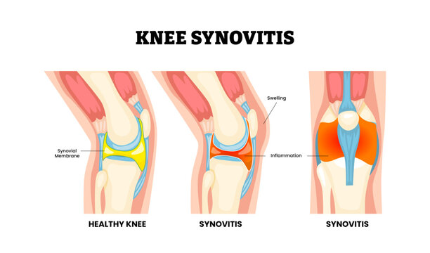 Knee synovitis knee injury. Labeled swelling and inflamed synovial membrane, excess synovial fluid, joint effusion. Synovial joint anatomy. Frontal side view of human knee joint. Vector illustration.