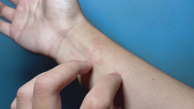 Footage of person scratching an itchy arm. Concept of skin allergy, eczema or insect bite causing irritation
