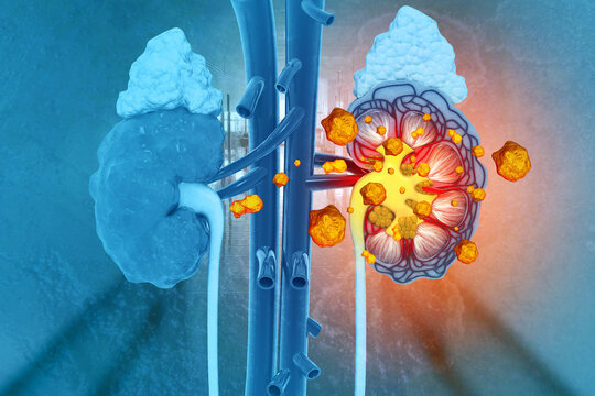 Kidney stone disease. Renal colic. Human Urinary System. 3d illustration