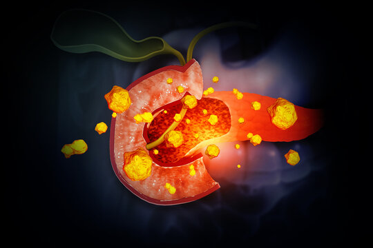 Visual concept of human gallbladder stone. 3d illustration