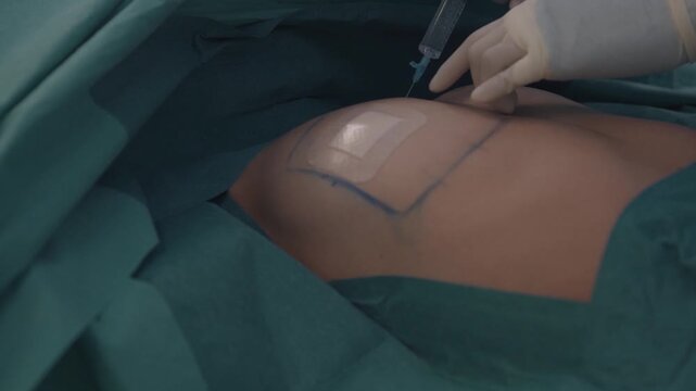 Plastic surgeon preparing a breast surgery intervention