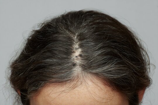 Multiple nevus growths on a person's head, demonstrating potential skin health concerns in the scalp area