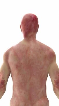Psoriasis on elbows, knees, and scalp as red patches with silver scales, triggered by genetics, stress, or infection
