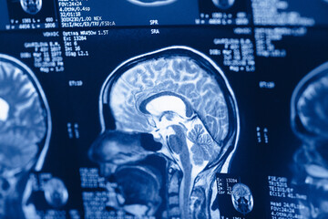 Brain scan showing detailed structures and measurements from a medical imaging procedure at a hospital in the morning © yurakrasil