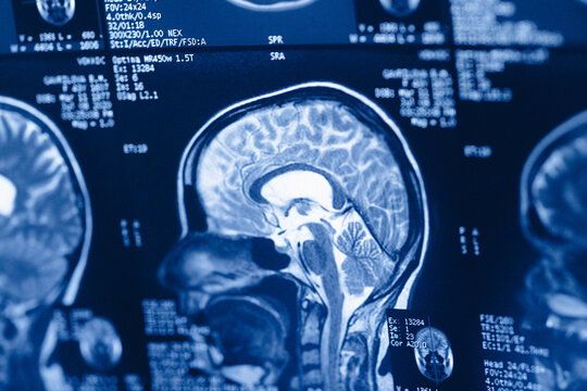 Brain scan showing detailed structures and measurements from a medical imaging procedure at a hospital in the morning