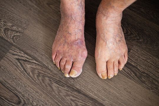 Elderly feet showing varicose veins and skin discoloration with fungus