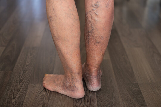 Patient showing severe varicose veins on legs