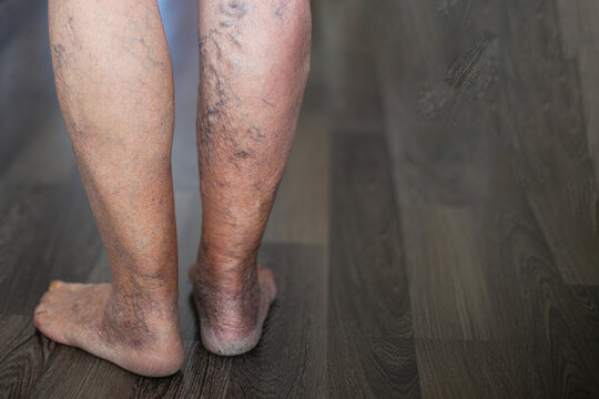 Patient showing severe varicose veins on legs