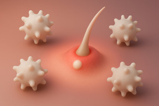 Dermatology concept of inflammatory acne with an immune cell response to an infected hair follicle on skin. biomedical illustration details pimple formation