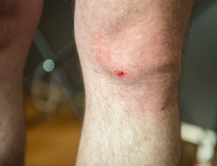 Fototapeta premium Closeup of human knee with small wound and redness showing minor injury and healing process.