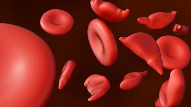 3D Medical Visualization of Schistocytes: Fragmented and Normal-Shaped Red Blood Cells Illustrating Mechanical Shearing and Microangiopathic Hemolytic Anemia.