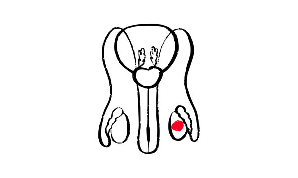 Testicular pathologies concept