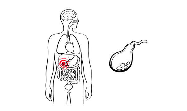 Human Gallbladder Disease