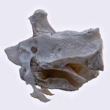 Key landmarks of ethmoid bone including crista galli, cribriform plate, and perpendicular plate