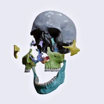 Exploded skull view showing neurocranium and viscerocranium bones in detailed anatomical separation.