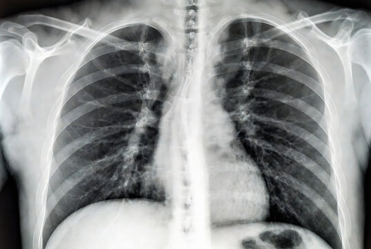 Chest X-ray of a patient with a large gastric bubble, likely due to ascites.