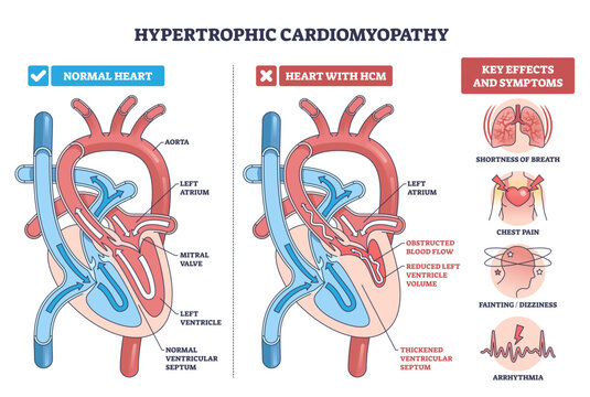 Hypertrophic cardiomyopathy diagram compares normal and HCM hearts, showing thickened septum, mitral valve obstruction, and reduced blood flow, key symptoms shown, transparent background.