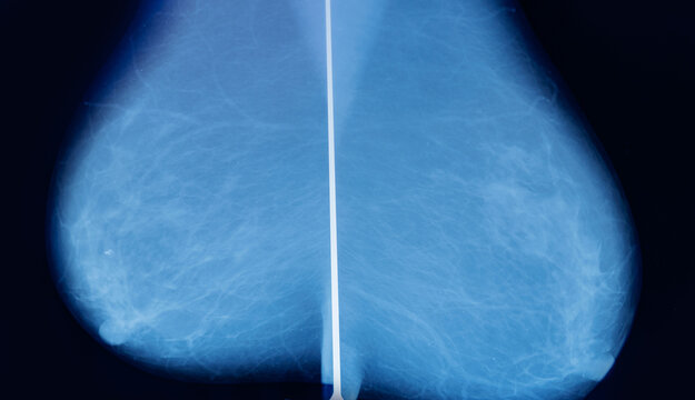 Breast tissue compressed and imaged on radiology lightbox, mammogram scan