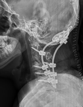 Lateral Cervical X-ray of Atlantoaxial Subluxation and Postoperative C1-C2 Spinal Fusion with Hardware.