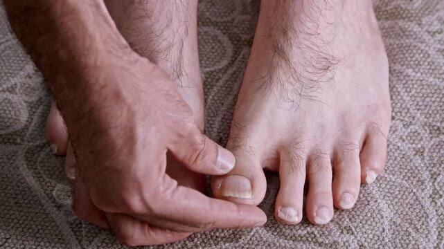 Close-up of a man's hands inspecting his hairy feet, checking his toenails for signs of fungus, onychomycosis, or other nail diseases