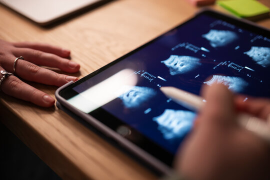 A person's hands are shown as they review medical ultrasound images on a tablet device, with one hand resting on the table and the other holding a stylus.