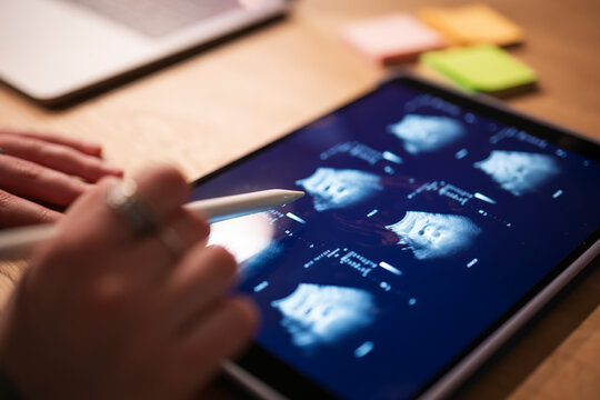 A person uses a stylus to interact with a tablet displaying medical ultrasound images, with a laptop and sticky notes in the background.
