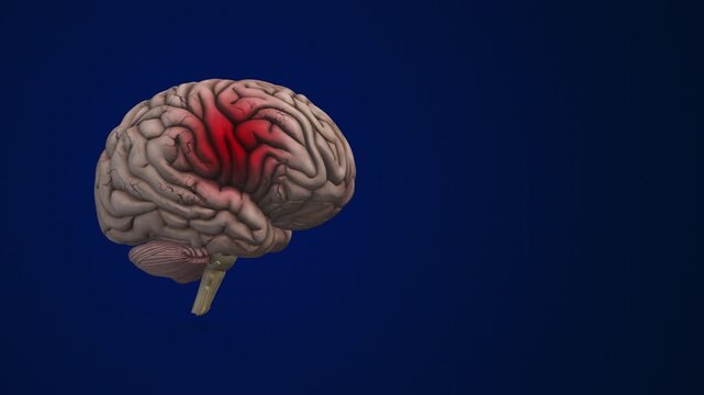 Brain Hemorrhage Intracranial Bleeding Medical Concept